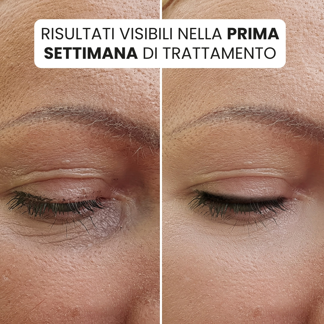 EyeLift® | Illumina il tuo sguardo